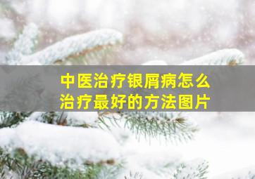 中医治疗银屑病怎么治疗最好的方法图片