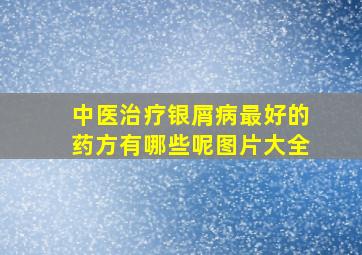 中医治疗银屑病最好的药方有哪些呢图片大全