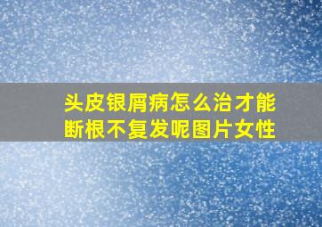 头皮银屑病怎么治才能断根不复发呢图片女性