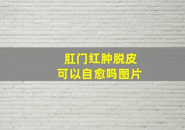 肛门红肿脱皮可以自愈吗图片