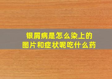 银屑病是怎么染上的图片和症状呢吃什么药