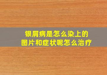 银屑病是怎么染上的图片和症状呢怎么治疗